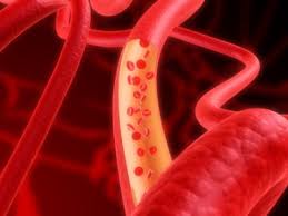 Cardiovascular Diseases Causes