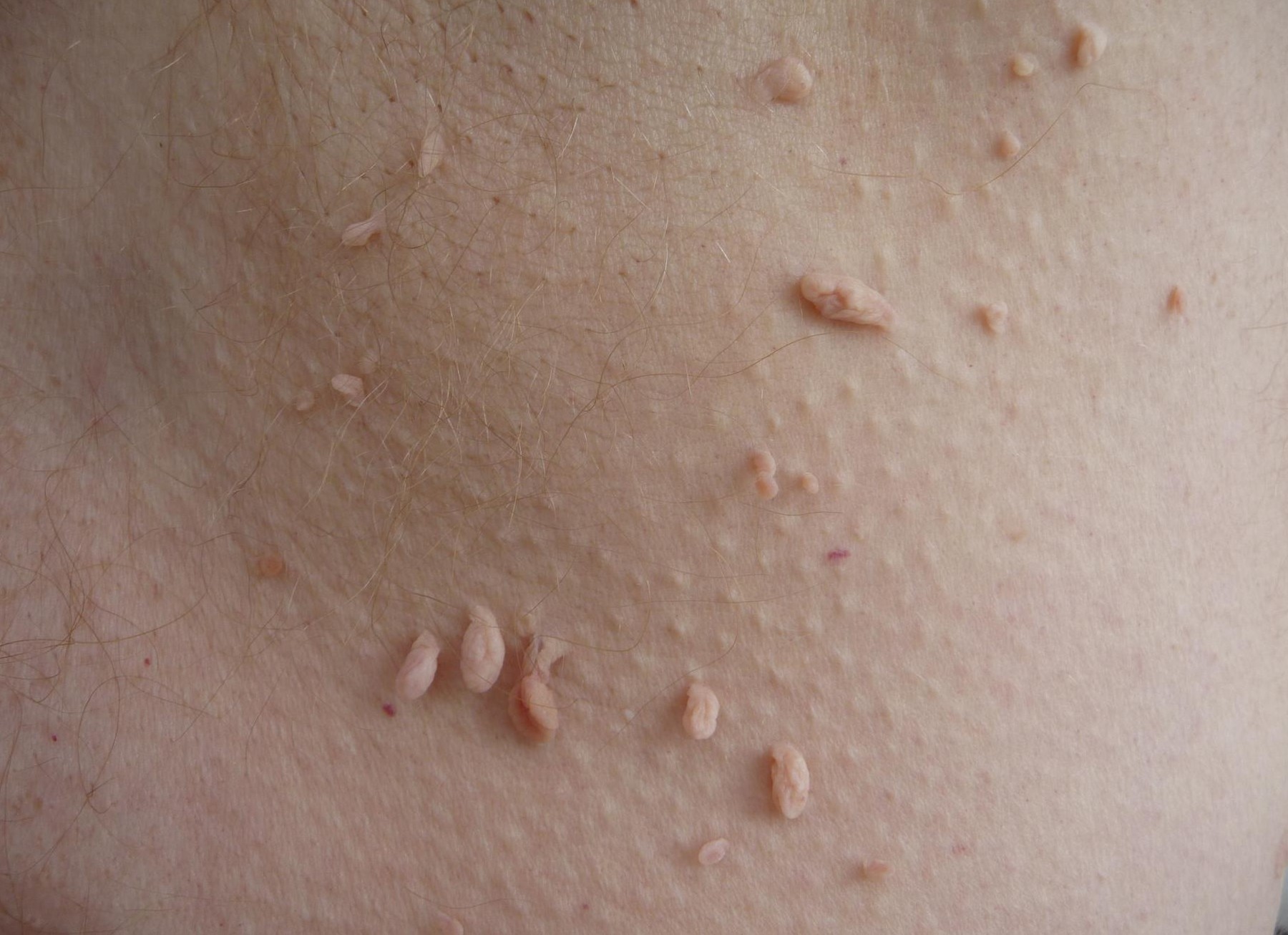 images of skin tags