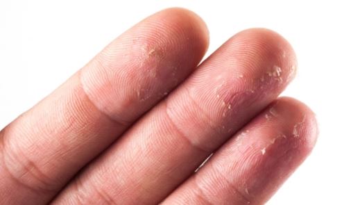 peeling fingertips skin causes dry fingers cracked remedies fungus vitamin deficiency near