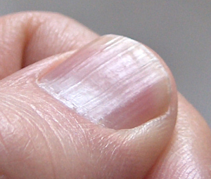 Lines on Nails? Vitamin Deficiency May Be the Culprit | Healthcare-Online