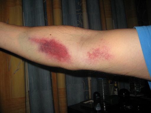 Bruising After Blood Test: Causes and Dealing Methods | Healthcare-Online